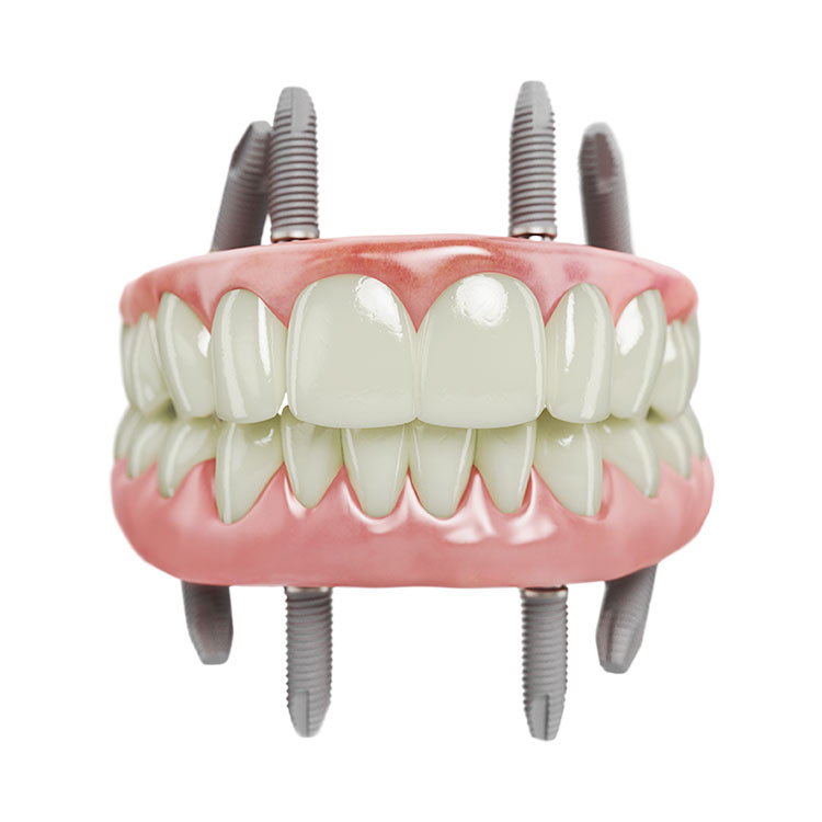 Sofort belastbare Implantate - Zahnarzt Bad Krozingen